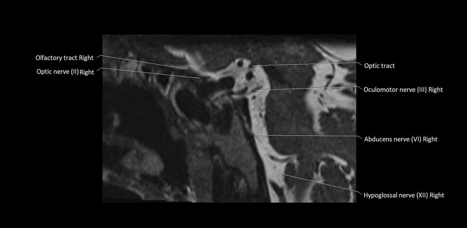 Cranial nerve sagittal anatomy MRI 3T image 38.webp